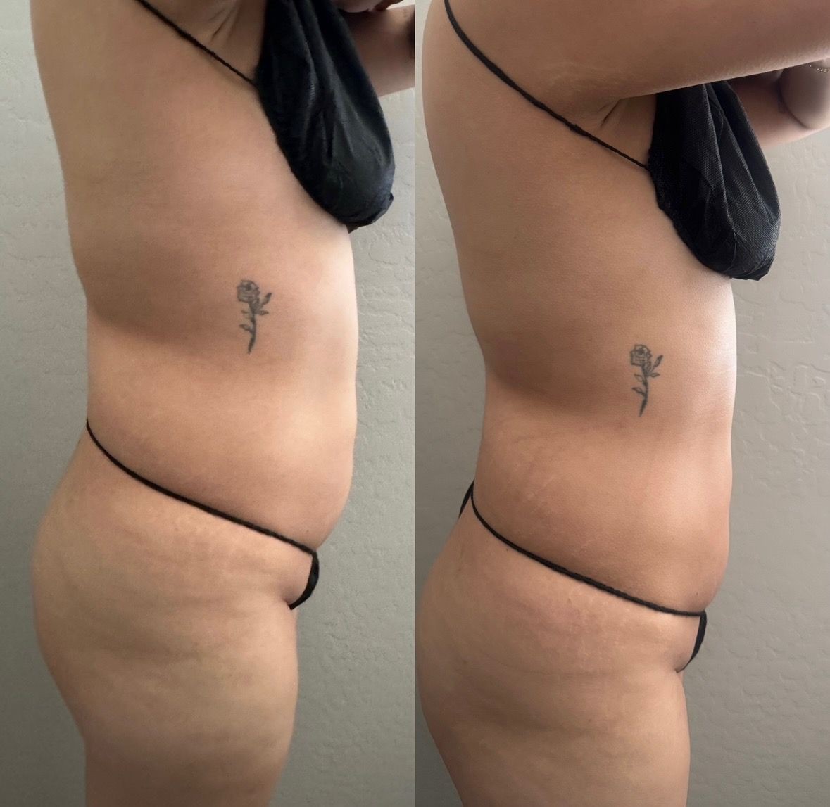 Non-Invasive Fat Reduction